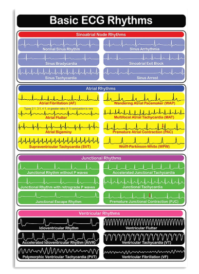 Basic ECG rhythms poster
