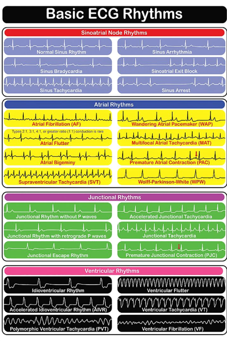 Basic ECG Rhythms poster